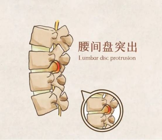 皇冠信用盘是什么意思_杏师堂透骨膏:腰椎间盘突出是什么意思