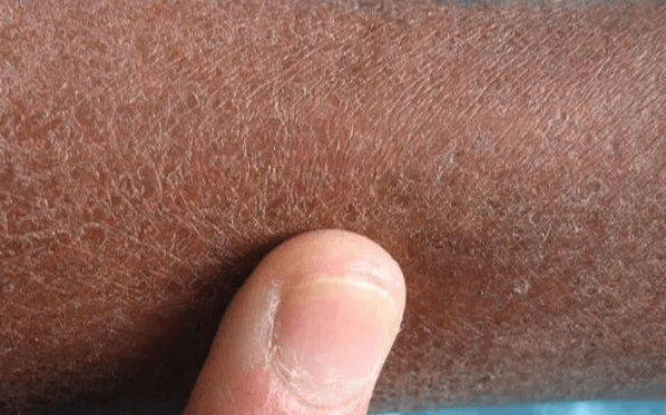 皇冠信用网结算日是哪天_世界硬皮病日是哪天皇冠信用网结算日是哪天?你知道它的由来吗?