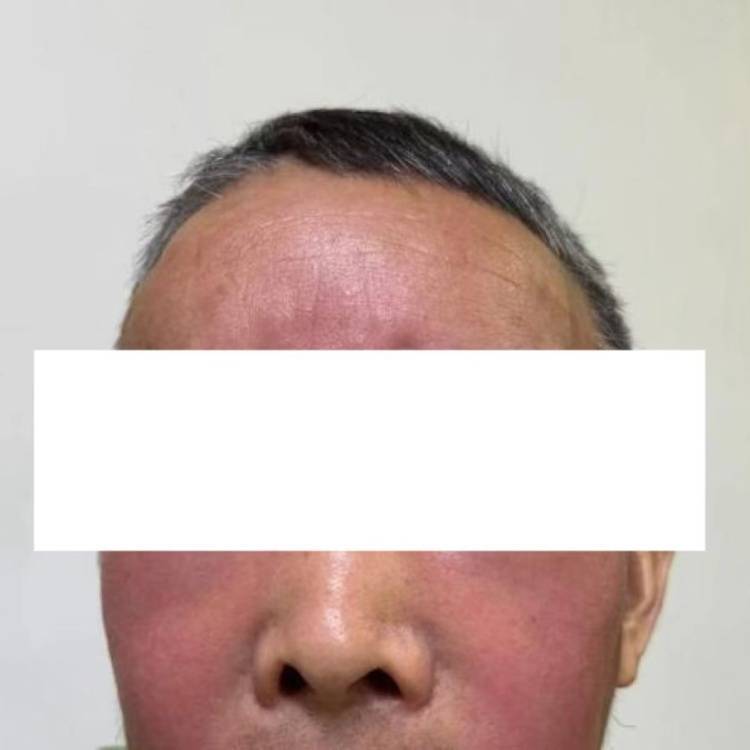 皇冠足球平台代理_杭州发生多起皇冠足球平台代理!面部肿成“馒头”!6小时内处理很重要