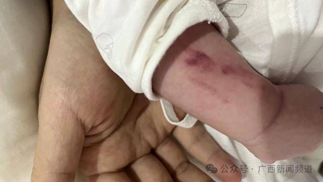 皇冠信用网代理_广西一月子中心有宝宝右手两处骨折皇冠信用网代理,家属求真相,警方介入调查