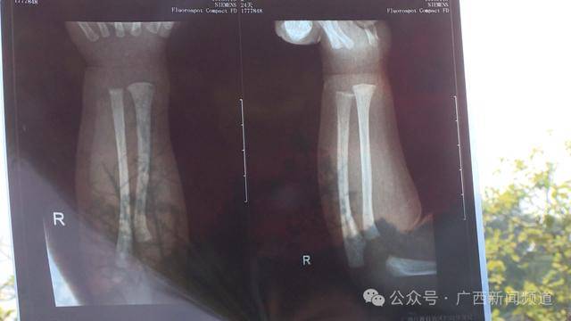 皇冠信用网代理_广西一月子中心有宝宝右手两处骨折皇冠信用网代理,家属求真相,警方介入调查
