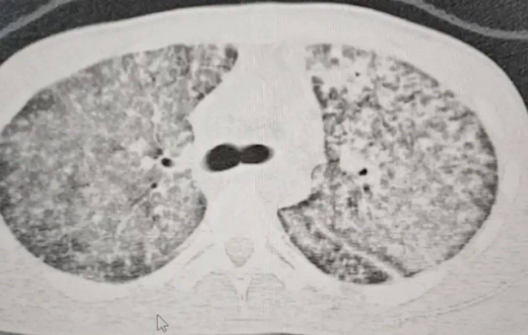 皇冠信用网开户_河南一大学生咳嗽发烧近一月皇冠信用网开户，多家诊所误当感冒治，医生：肺已全白