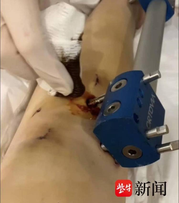 非洲足球冠军联赛_女子去国外“断骨增高”非洲足球冠军联赛，后遗症缠身维权难：像有定时炸弹藏在身体里