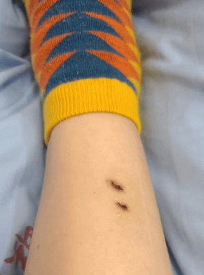 新2網址_女子在云南被银环蛇咬伤打了十多支血清新2網址，自称2年后仍有后遗症：头晕脸麻，没想到恢复得这么慢