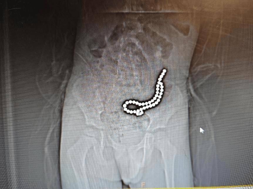 拜仁慕尼黑足球_整整37颗拜仁慕尼黑足球！云南4岁孩子身体里取出……医生紧急提醒！