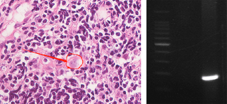 2025-2026欧洲联赛冠军杯赛赛程积分_上海确诊1例！张文宏团队参与会诊！病死率极高2025-2026欧洲联赛冠军杯赛赛程积分，发病一周内迅速恶化