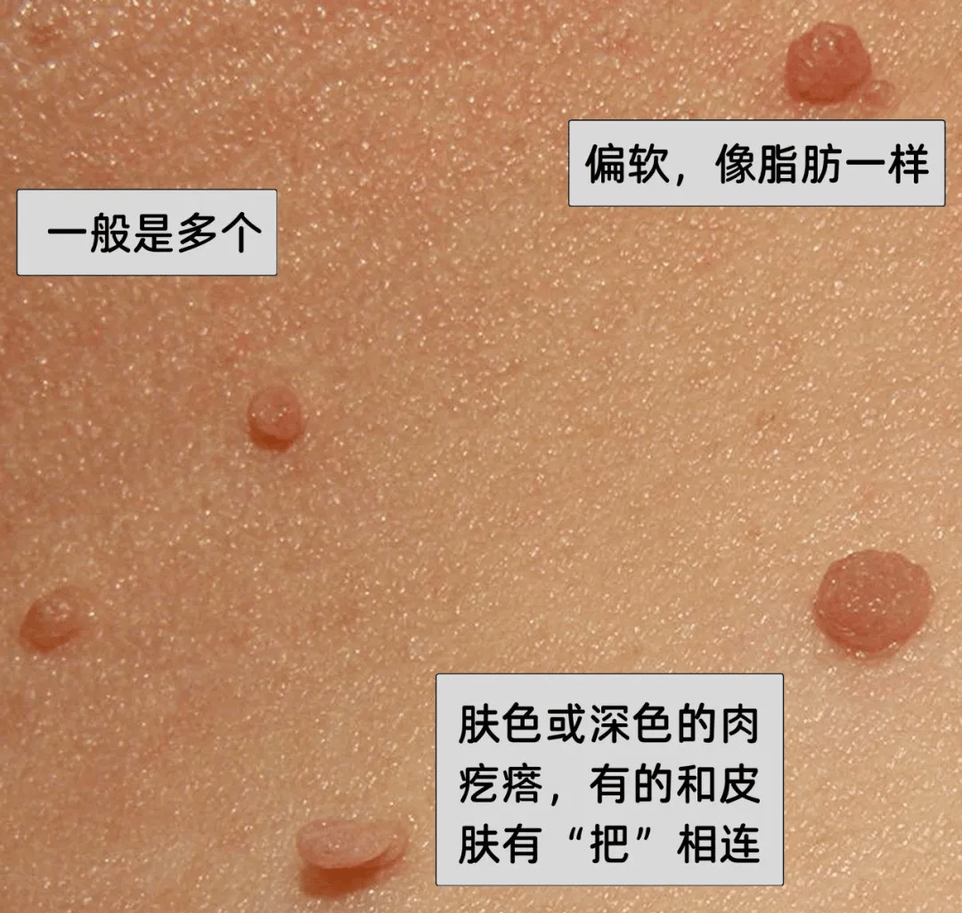 皇冠信用盘网址_脖子上长出的小肉粒皇冠信用盘网址，能揪吗？