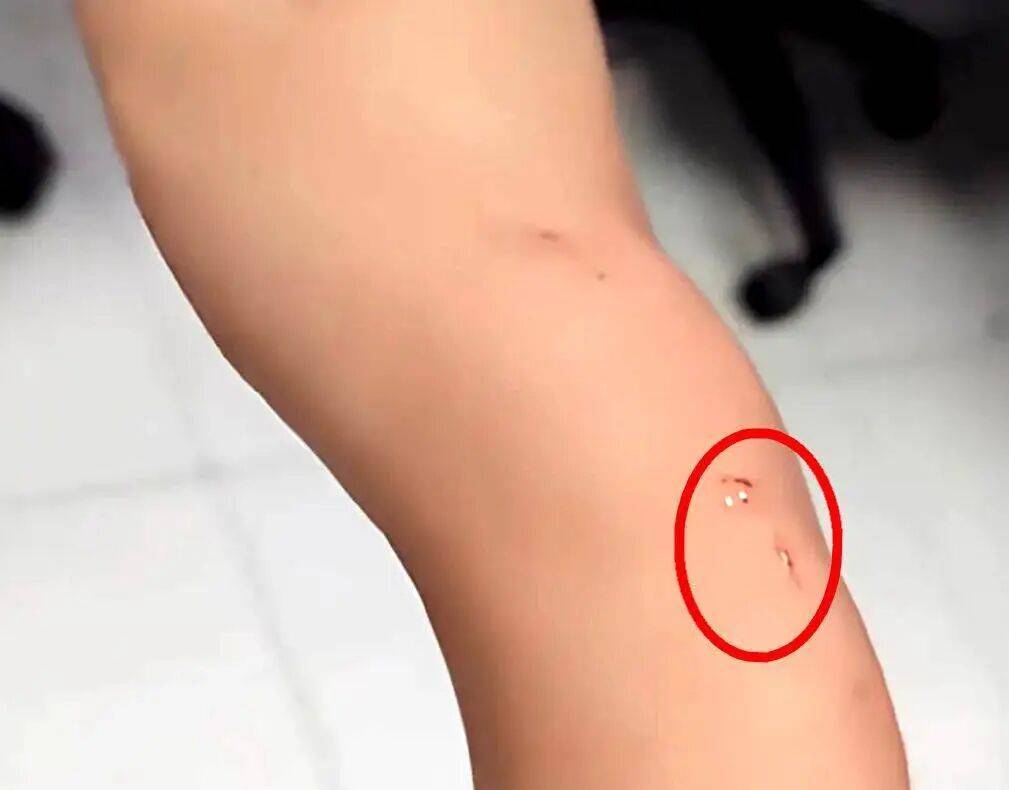 welcome皇冠注册_一旦被咬伤就是Ⅲ级暴露！家中闯入“不速之客”welcome皇冠注册，千万别徒手抓