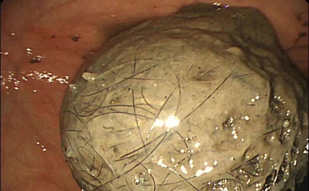 皇冠平台_发现一例皇冠平台，10岁女孩确诊！已有多起病例，有人因羞耻感延误就医