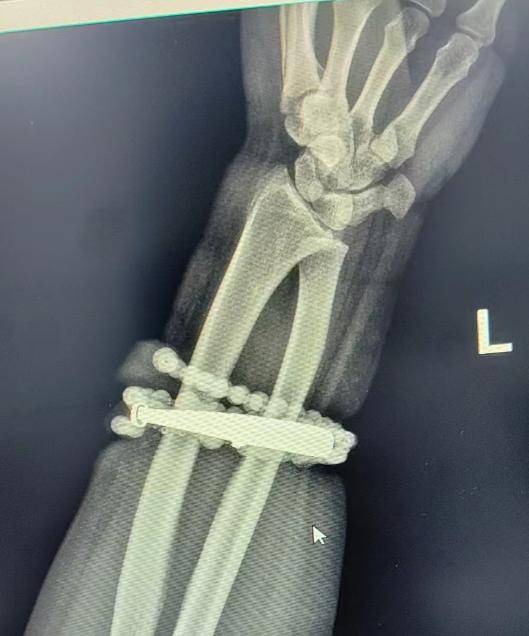 登1信用盘代理
_女子手镯10年没摘竟“长”进肉里登1信用盘代理
!医生:再晚点就保不住了