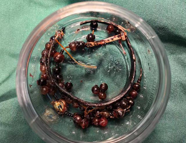 登1信用盘代理
_女子手镯10年没摘竟“长”进肉里登1信用盘代理
!医生:再晚点就保不住了