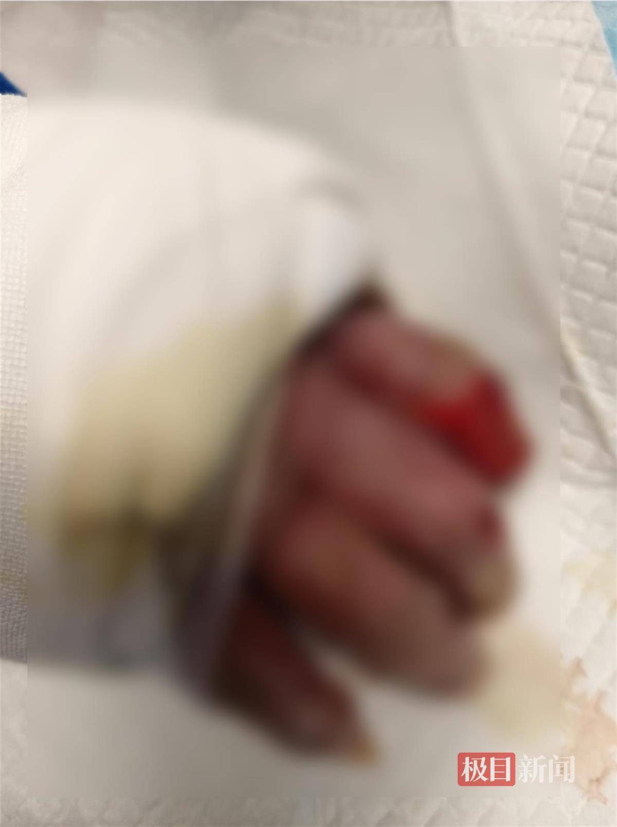 皇冠信用盘怎么开户_男子帮邻居关液化气瓶遭遇爆炸皇冠信用盘怎么开户，严重烧伤4个月后不幸离世，家属：治伤花了近140万，将为他申请见义勇为